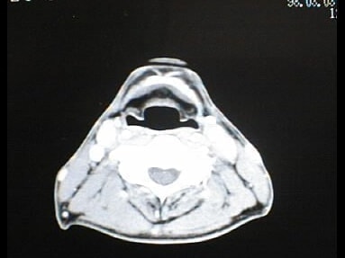 中咽頭末期がん消滅CT画像②