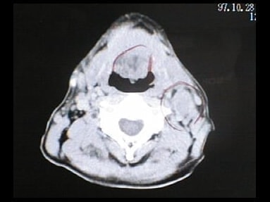 中咽頭末期がんCT画像③