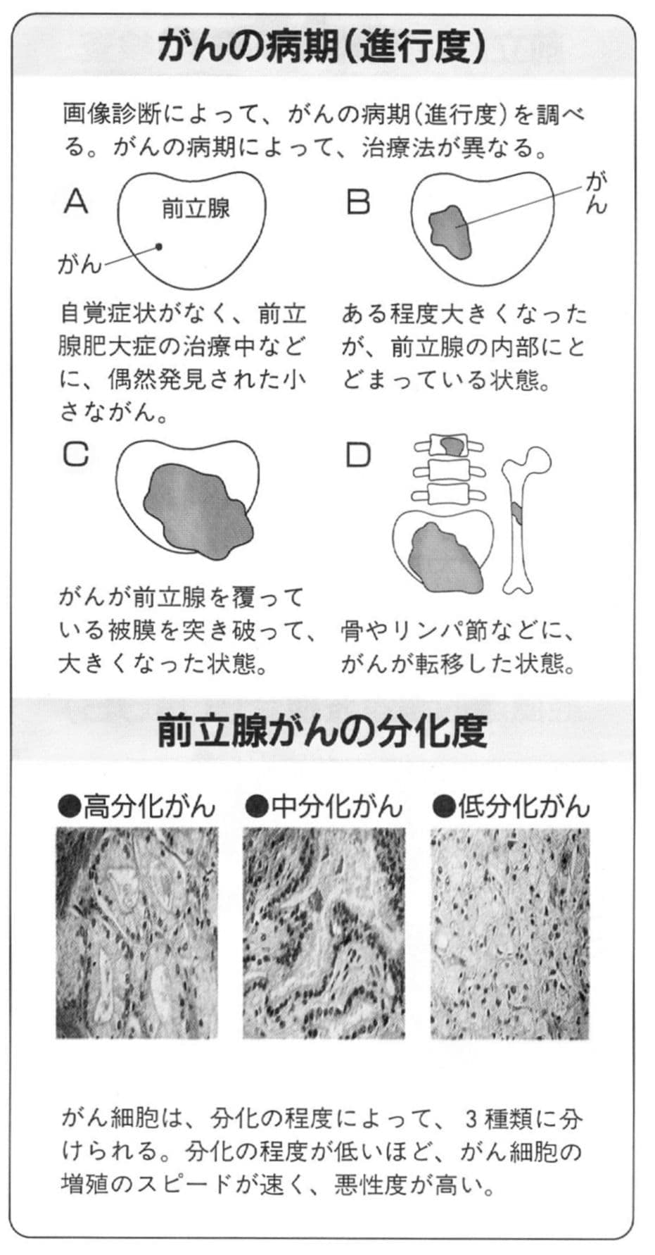 前立腺がんの進行度と分化度