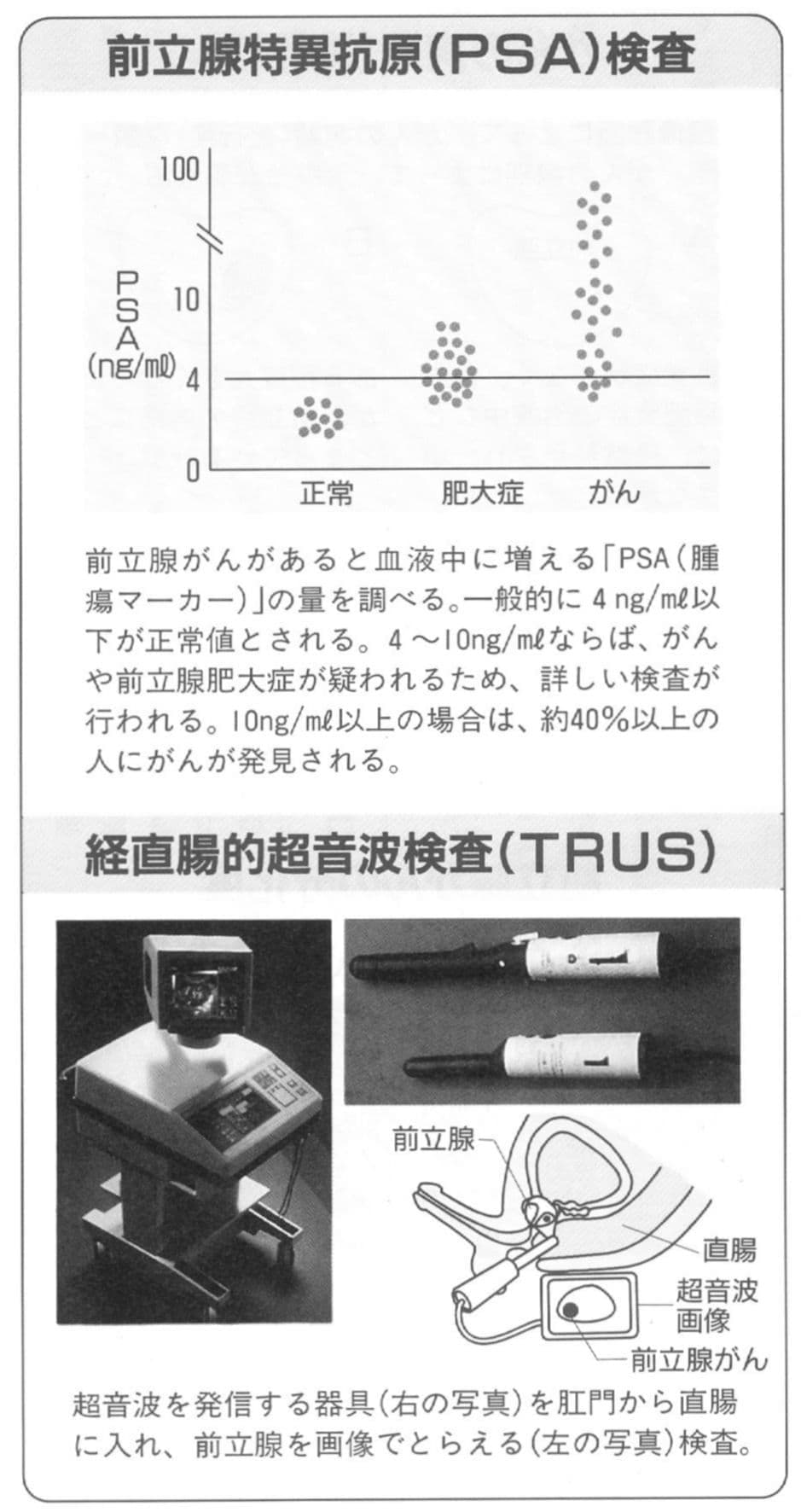 前立腺特異抗原PSA検査とは