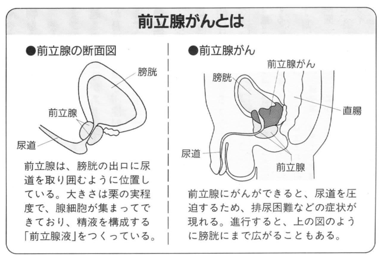 前立腺がんとは