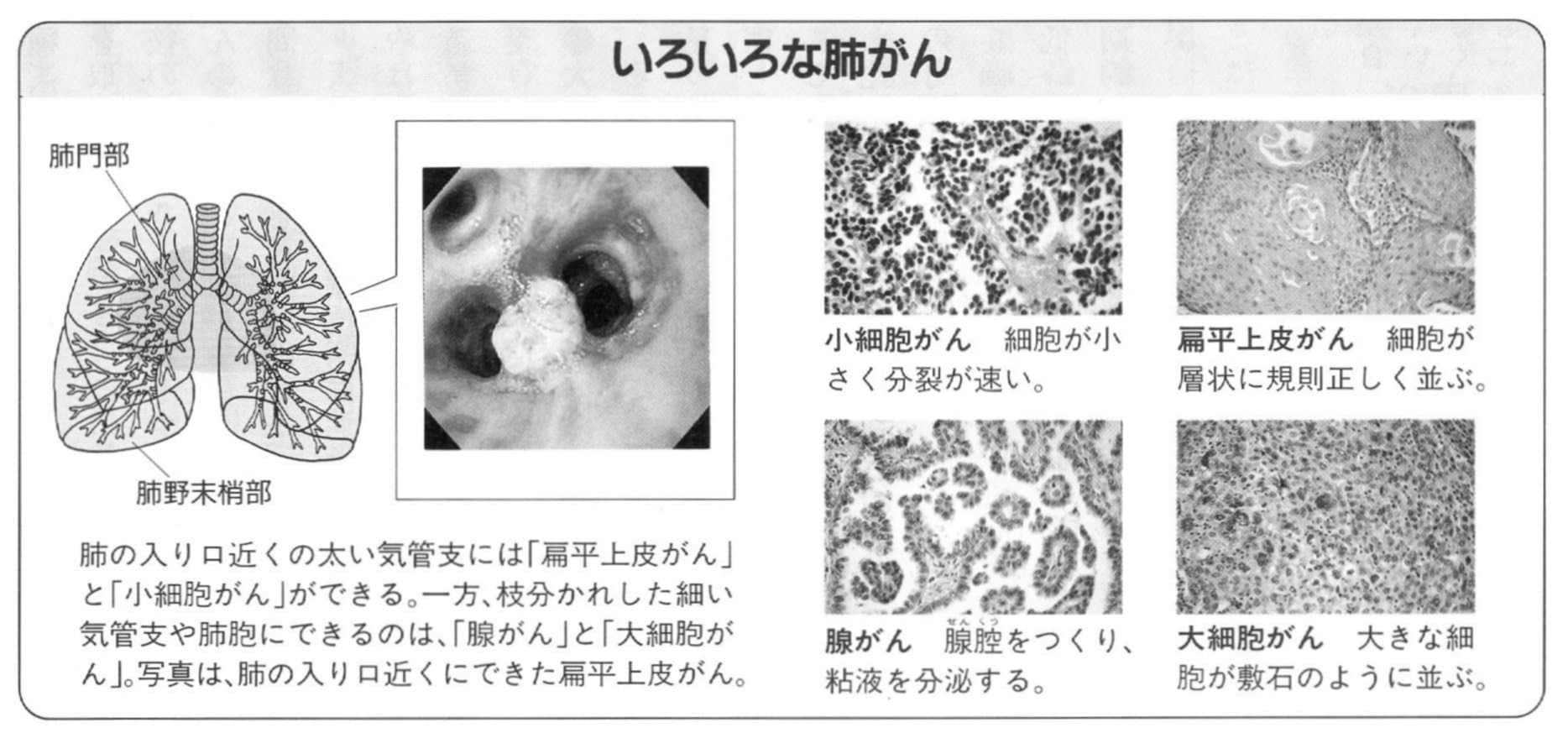 いろいろな種類の肺がん
