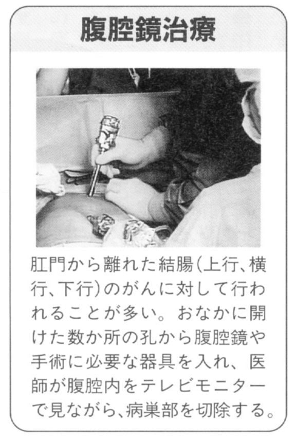 大腸がんの腹腔鏡治療