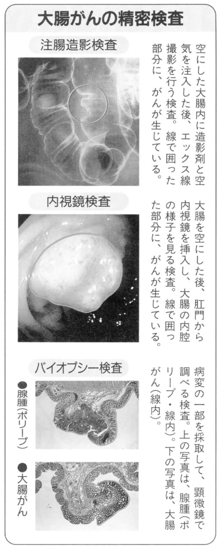 大腸がんの精密検査
