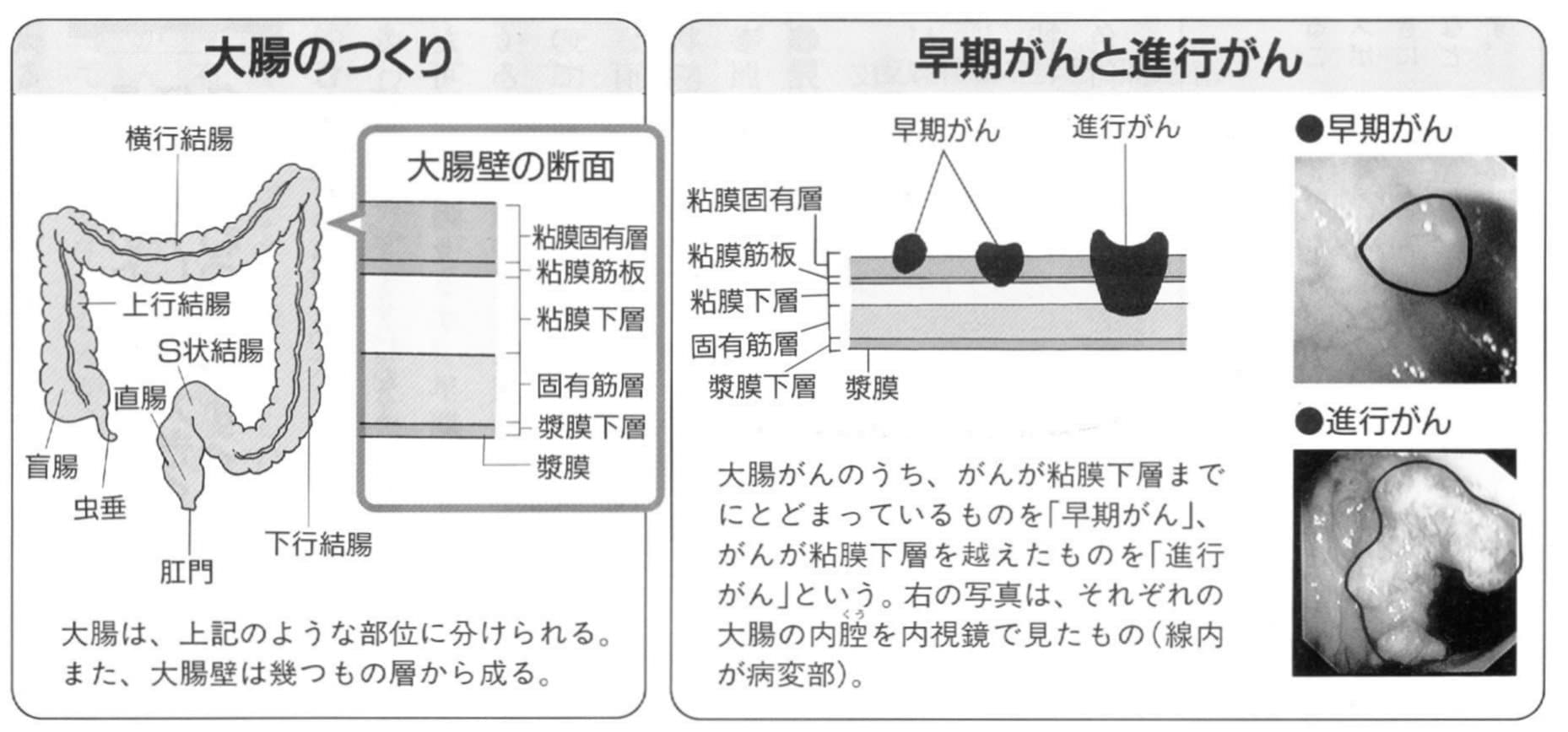 大腸がんの「早期がん」と「進行がん」