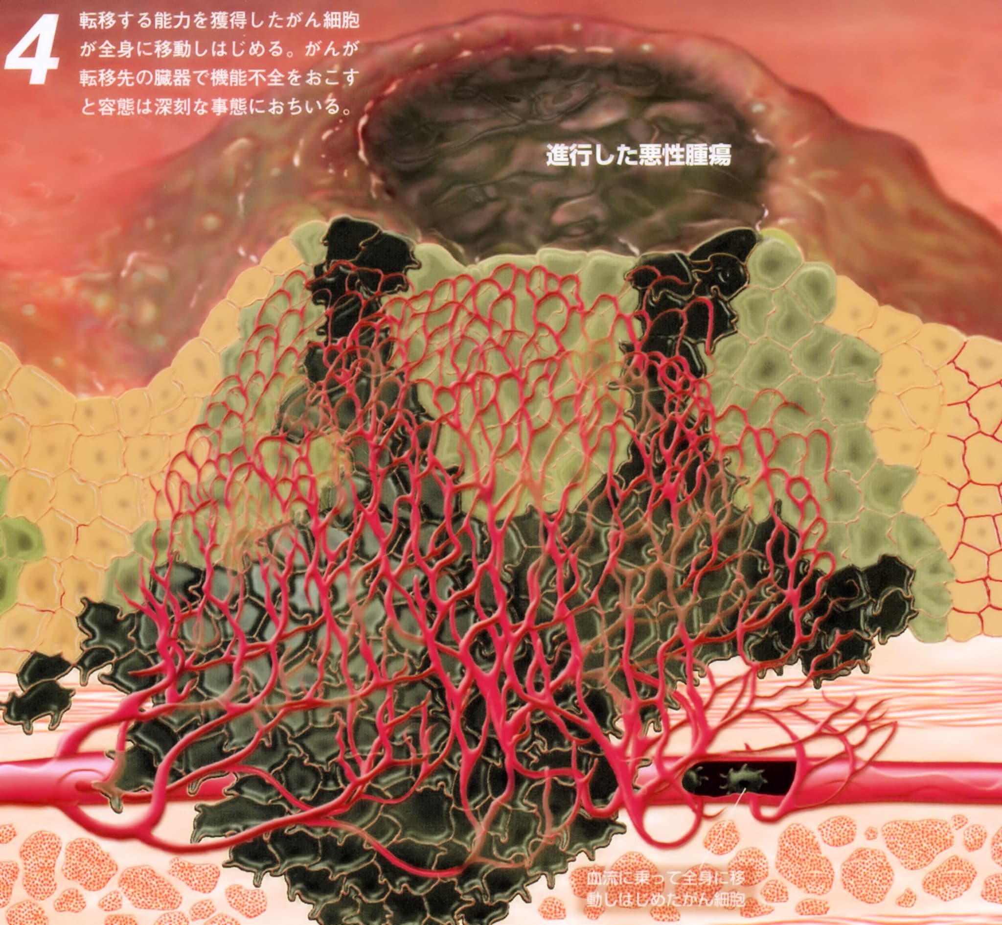 進行した悪性腫瘍「癌」（末期癌からの生還）
