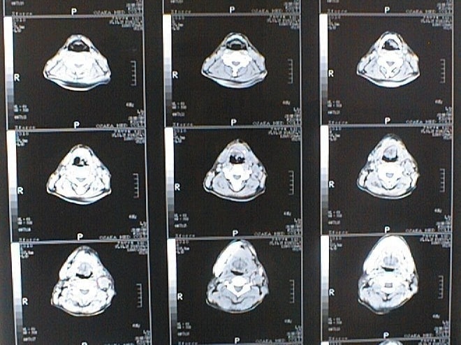 中咽頭末期がんCT画像①
