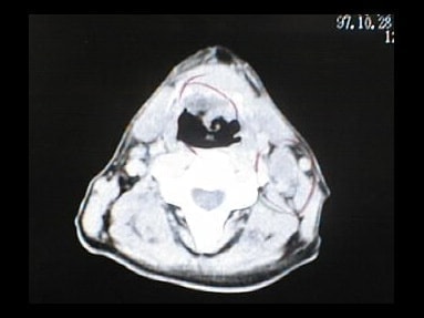 中咽頭末期がんCT画像②