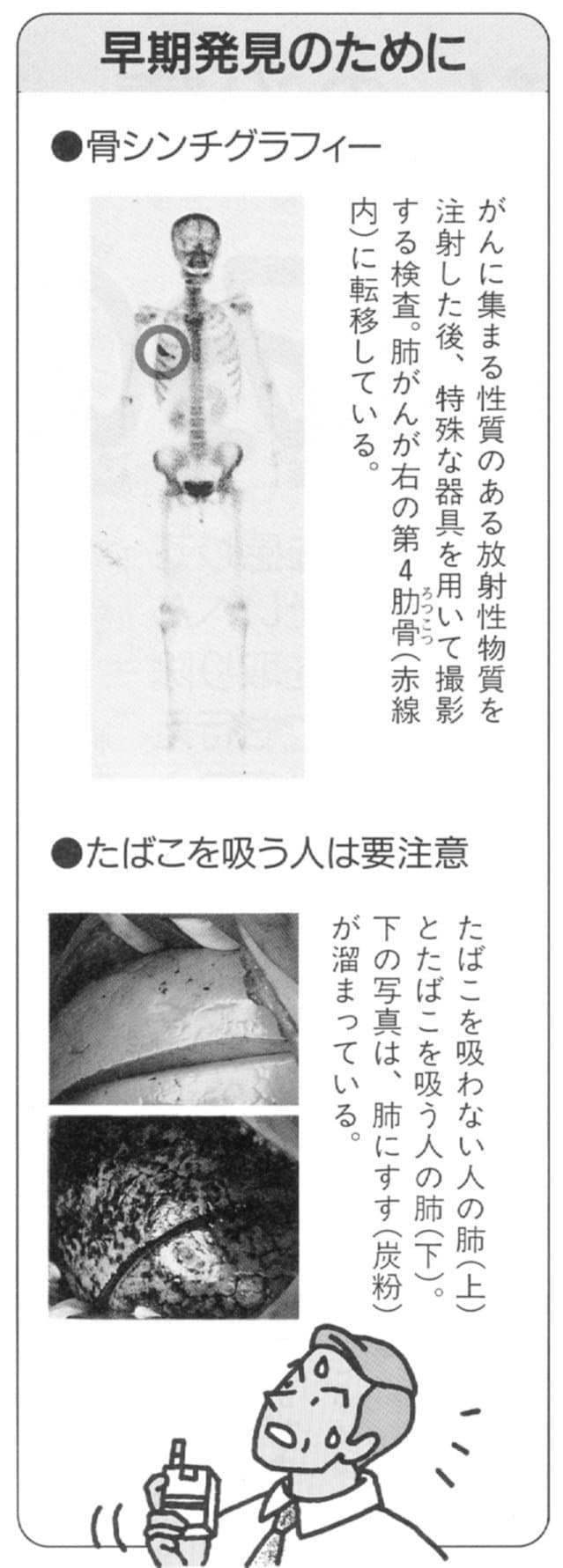 肺がんの早期発見のためにすべきこと