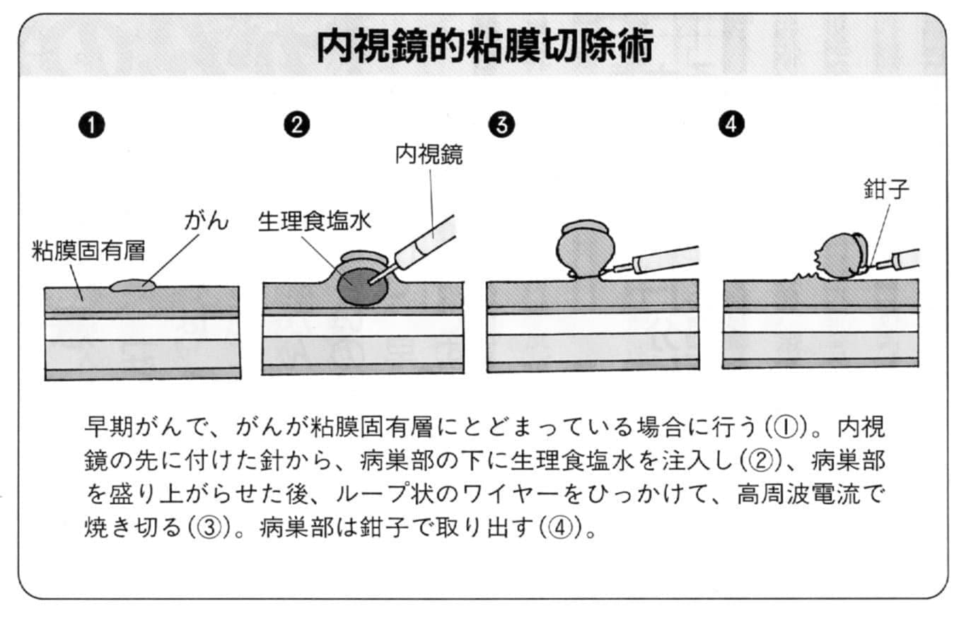 大腸がんの内視鏡的粘膜切除術