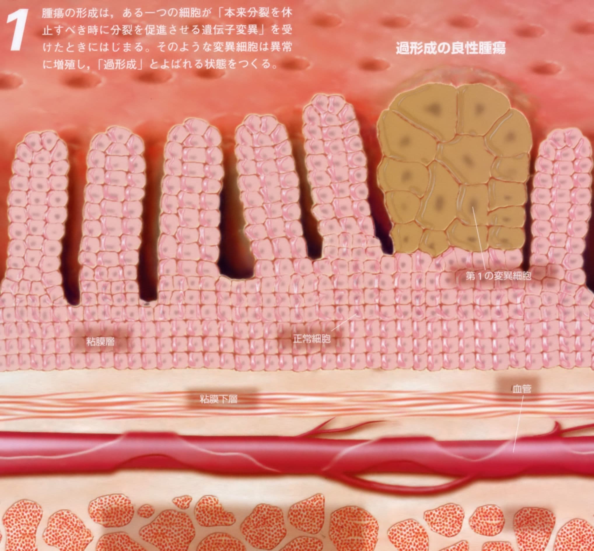 過形成の良性腫瘍（末期癌からの生還）