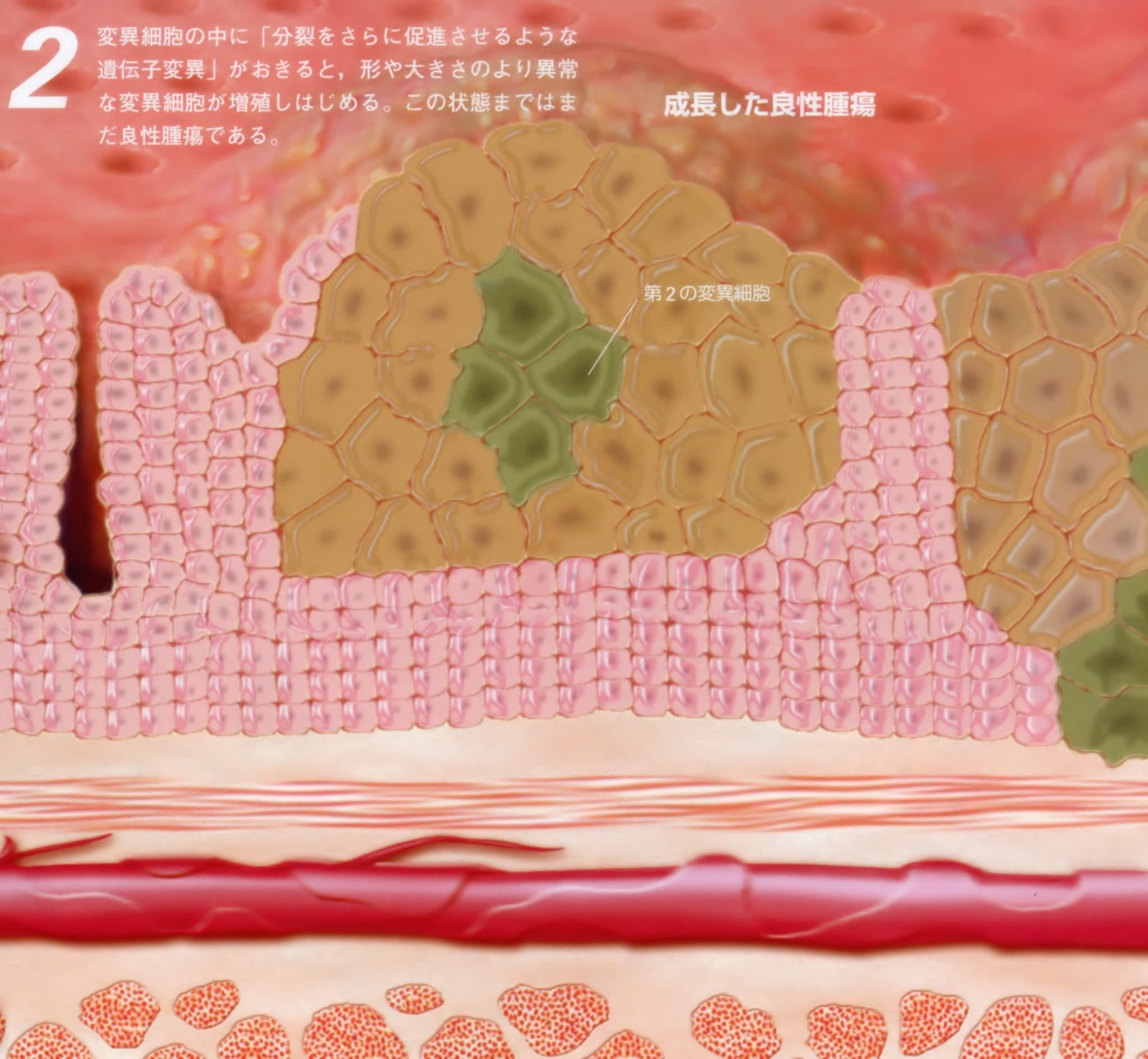 成長した良性腫瘍（末期癌からの生還）